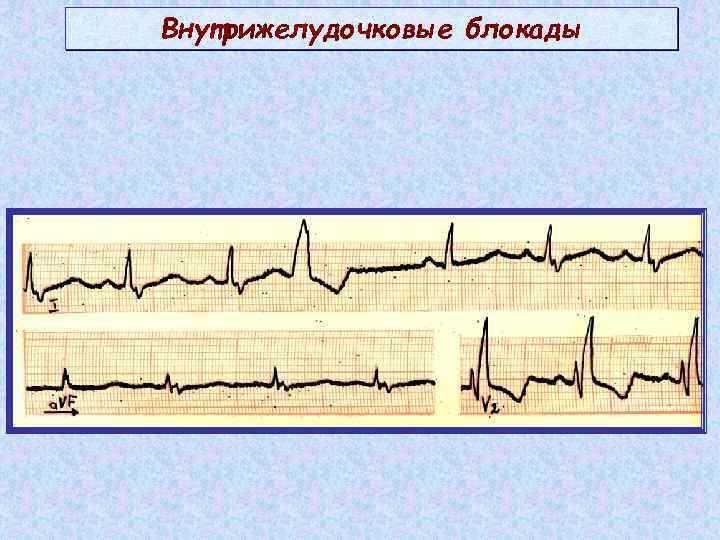 Нарушение ритма сердца. как предотвратить нарушение проводимости сердца