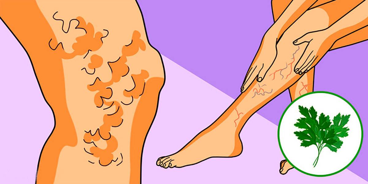 Варикозное расширение вен нижних конечностей (варикоз на ногах): лечение и диагностика симптомов, причин в москве