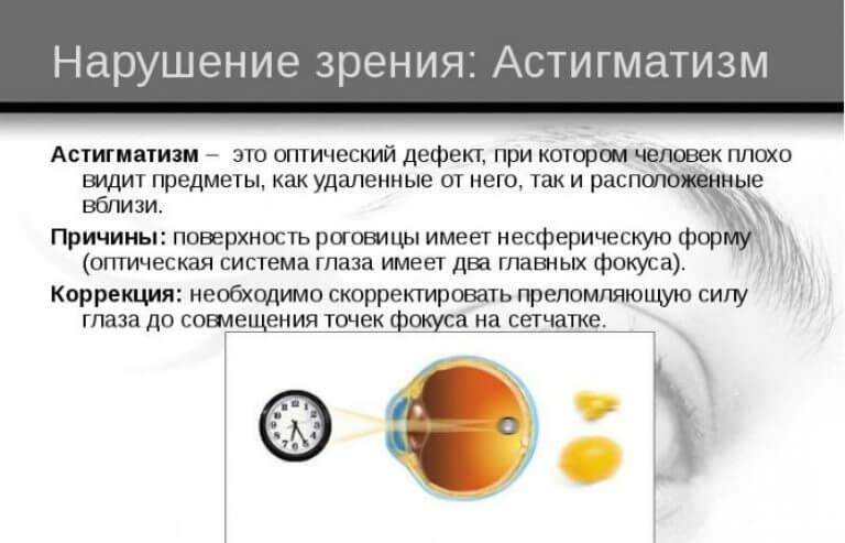 Глазное заболевание астигматизм: лечение - энциклопедия ochkov.net