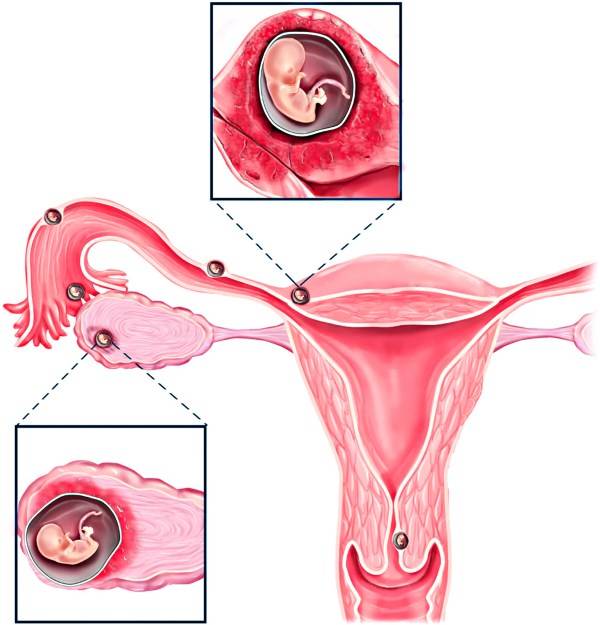 ᐈ внематочная беременность ⏩【причины и последствия】