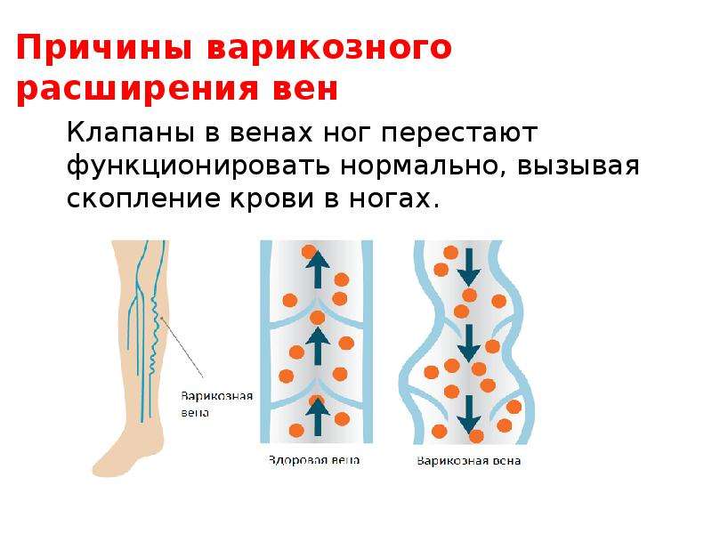 Боли при варикозном расширении. Варикозная болезнь вен нижних конечностей стадии. Варикозное расширение вен конечностей этиология. Расширенные вены нижних конечностей.