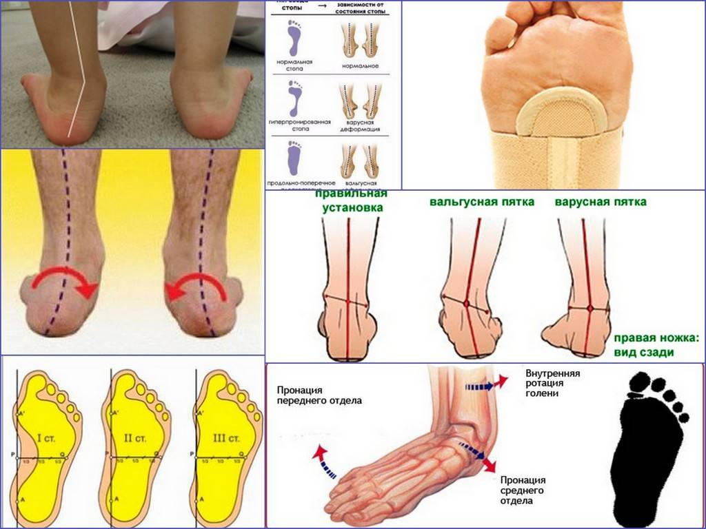 Вальгус фото стоп у ребенка