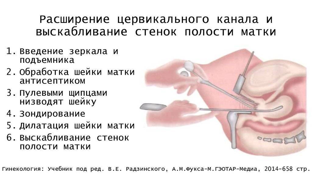 Полип шейки матки - цены на лечение, симптомы и диагностика заболевания в клинике «мать и дитя» в москве