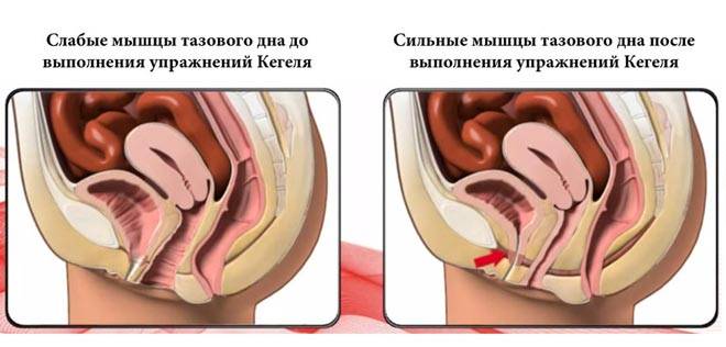 Роды с рубцом на матке: способы и условия | роды после кесарева сечения