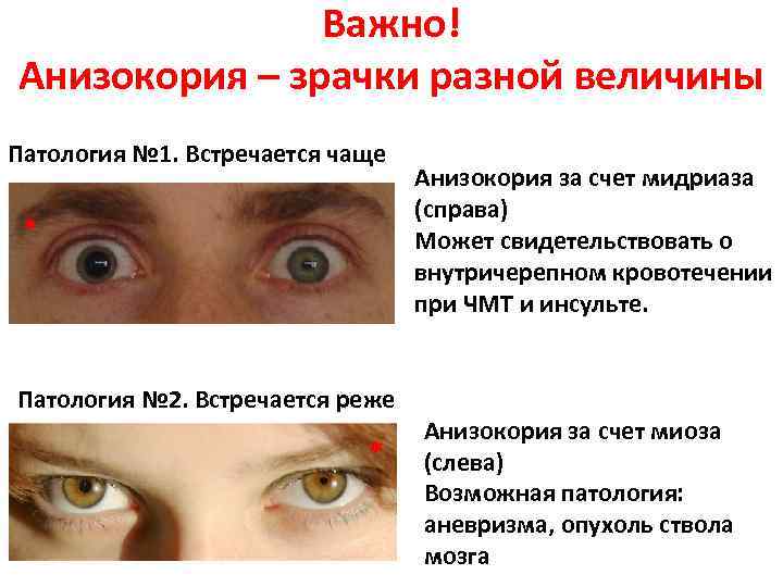 Зрачки наркомана: как определить зависимость по глазам