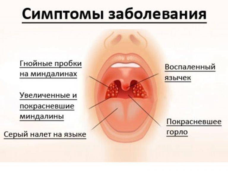 ➤ безопасное лечение боли в горле при грудном вскармливании