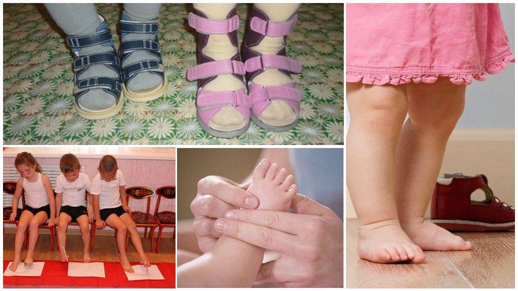 Плоская стопа: можно ли исправить плоскостопие у ребёнка? | здоровье | аиф красноярск