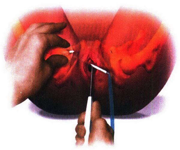 Лапароскопия миомы матки: послеоперационный период, как ее делают в гинекологии, можно ли удалить матку?
лапароскопическая операция при миоме « «евроонко»