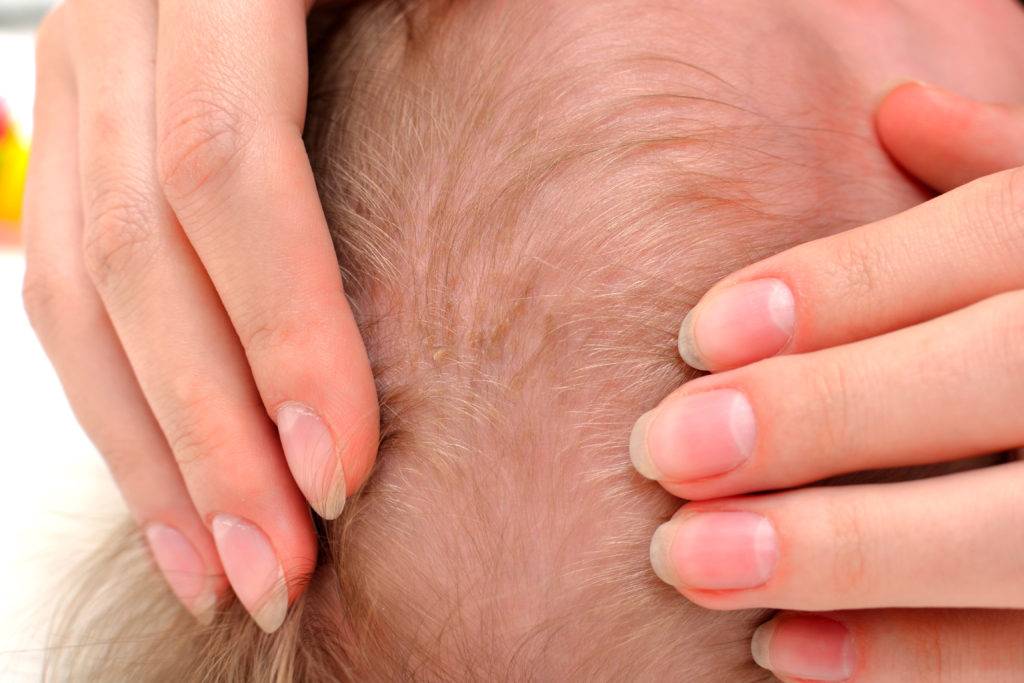 Сухость кожи головы у ребенка: симптомы и лечение