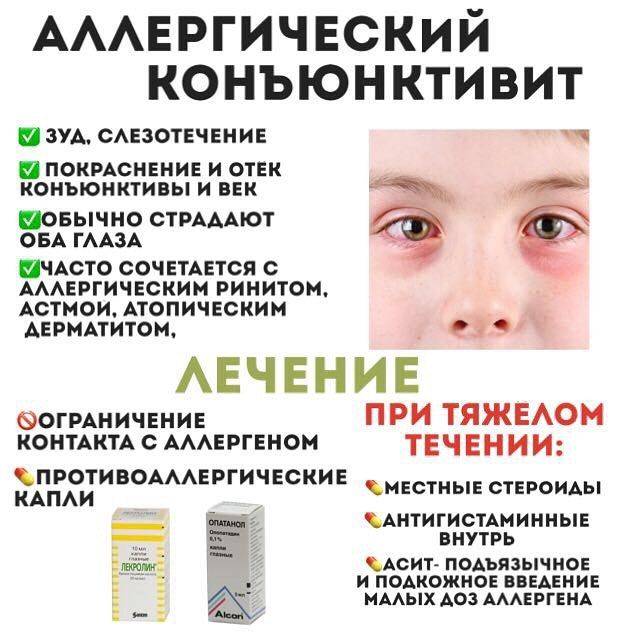 Лечение детского конъюнктивита в домашних условиях - энциклопедия ochkov.net