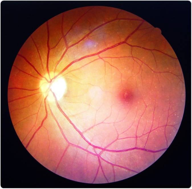 Ангиопатия сетчатки глаза у ребенка — что это, лечение, причины, симптомы