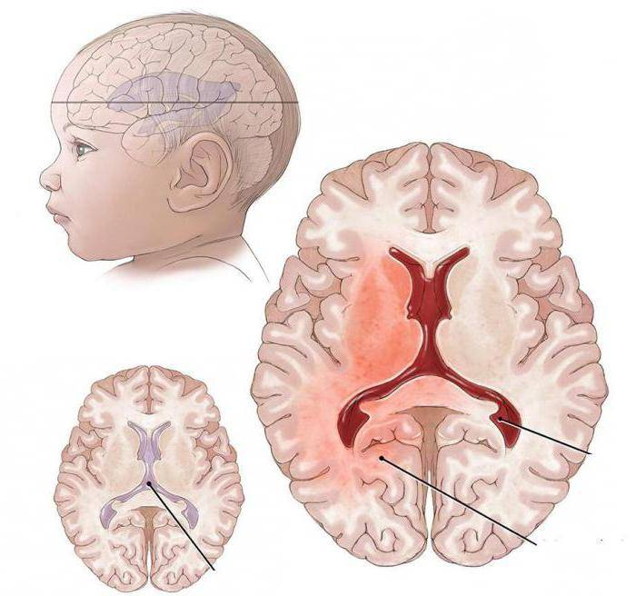 Церебральная ишемия у новорожденных 1, 2, 3 степени: причины, симптомы, последствия, лечение