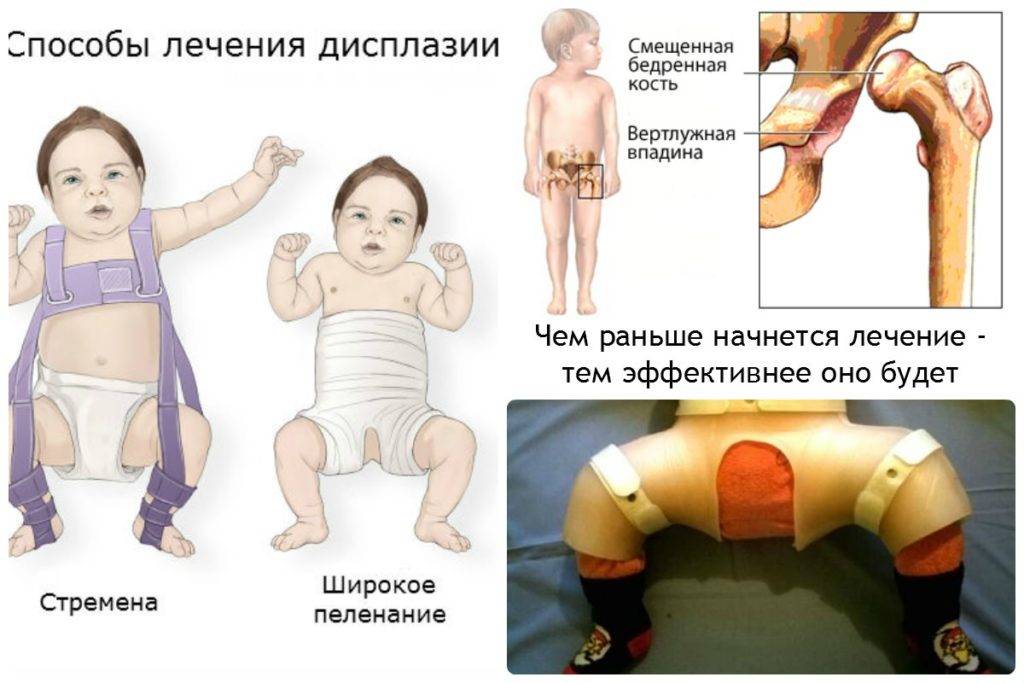 Узи тазобедренных суставов у грудничков, узи тазобедренных суставов у новорожденных: когда делать?