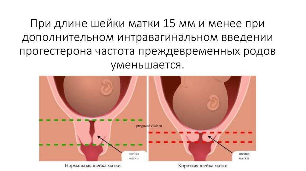 Укорочение шейки матки на 20 неделе беременности