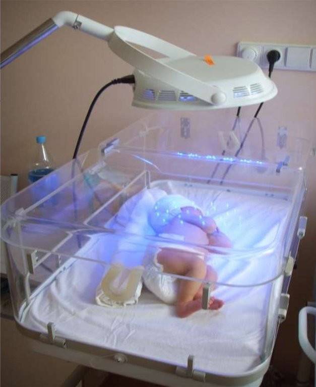 Фототерапия у новорожденных детей: показания, ограничения, методика проведения, результаты