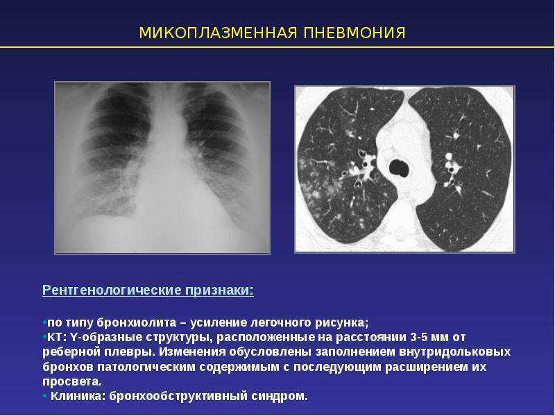 Вирусная пневмония