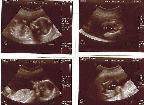 Виден ли пол будущего ребенка на узи диагностике в 15 недель беременности?