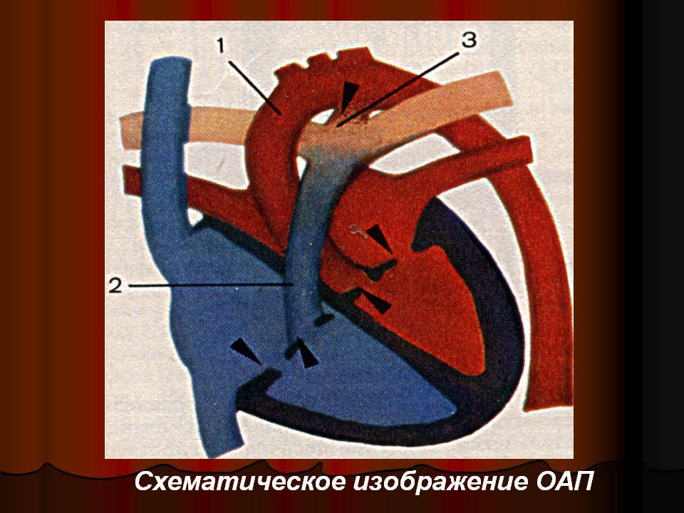 Оап у детей: лечение открытого артериального протока