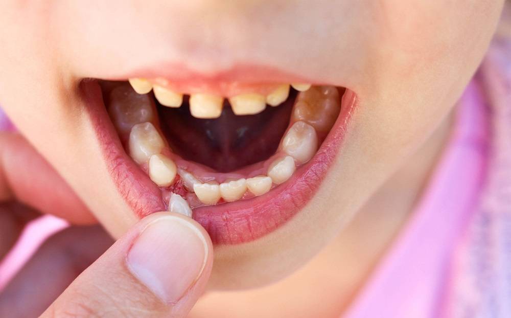 Пульпит – лечить или удалять зуб