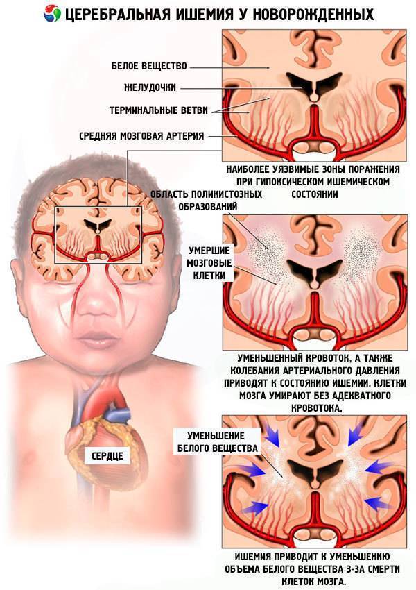 Ишемия головного мозга у новорожденного