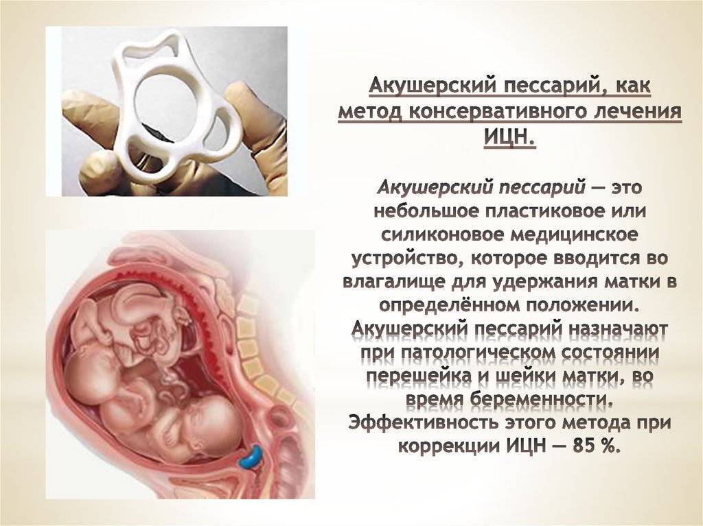 Пессарий при опущении матки — лечение пролапса без операции * клиника диана в санкт-петербурге