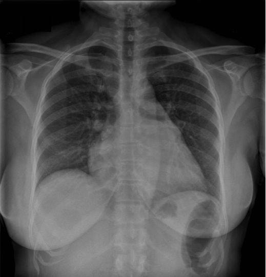 Рентгенография грудной клетки