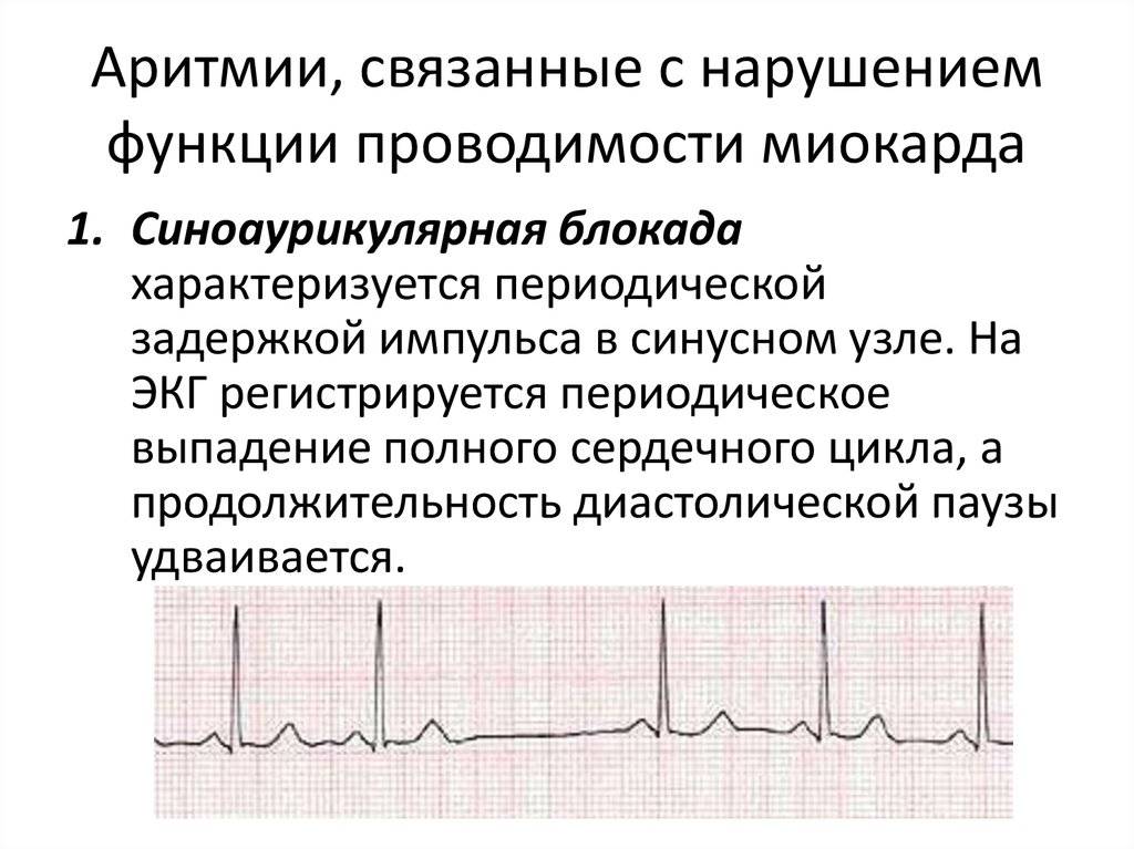 Связанных с нарушениями функции. Синусовая Мерцательная аритмия ЭКГ. ЭКГ нарушения ритма и проводимости. ЭКГ при нарушениях ритма и проводимости. Электрокардиография функция проводимости.