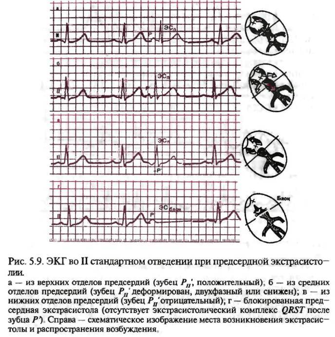 Экстрасистолия у детей