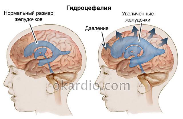 Ишемия сосудов  головного мозга: симптомы, лечение | последствия хронической ишемии головного мозга.