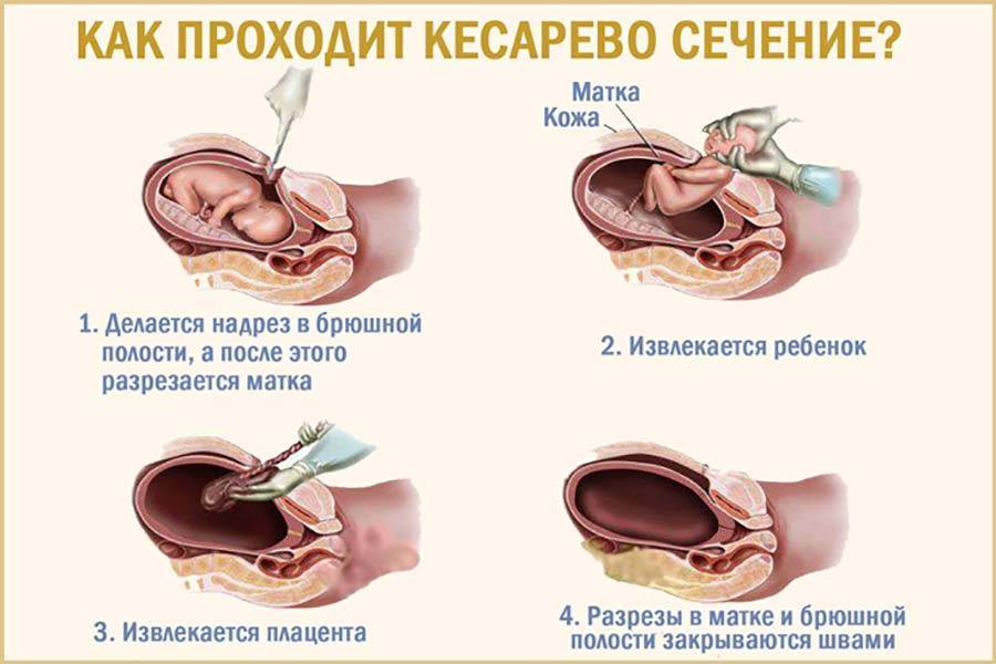 Плановое кесарево сечение и экстренное кесарево сечение