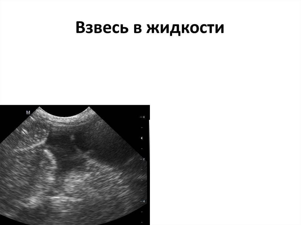Гипоксия плода. симптомы, признаки, последствия