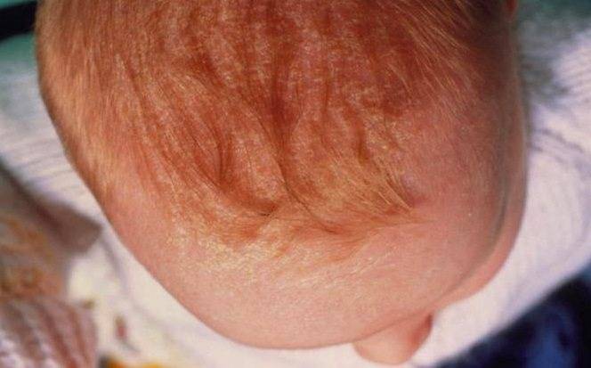 Себорейный дерматит у детей: что делать с «молочными корочками» на голове? - euroderm