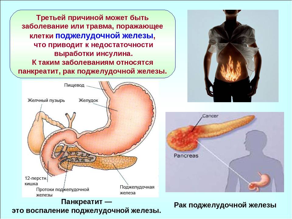 Болезни желудка и поджелудочной. Нарушение поджелудочной железы. Заюолеваниеподжелудочной. Больная поджелудочная железа.