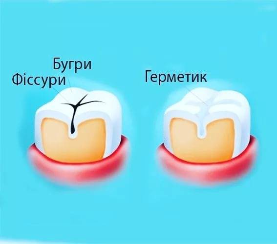 Герметизация фиссур зуба, стоимость герметизации фиссур в клинике цэлт.