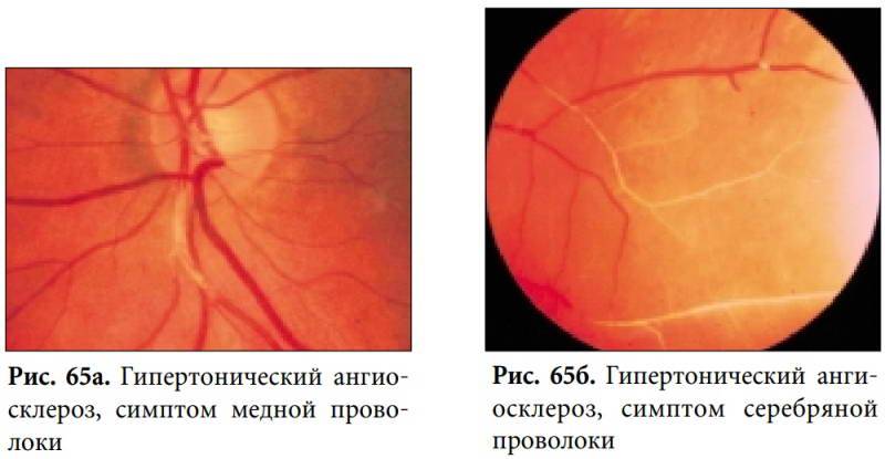 Как проявляется диабетическая ретинопатия
