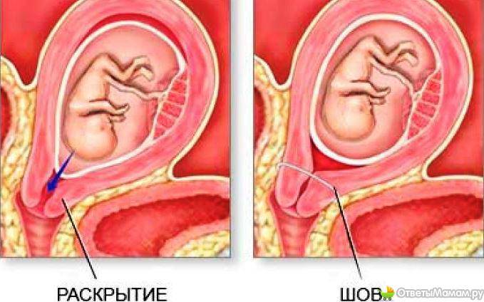 Акушерский пессарий, как метод коррекции ицн и предупреждения преждевременных родов.