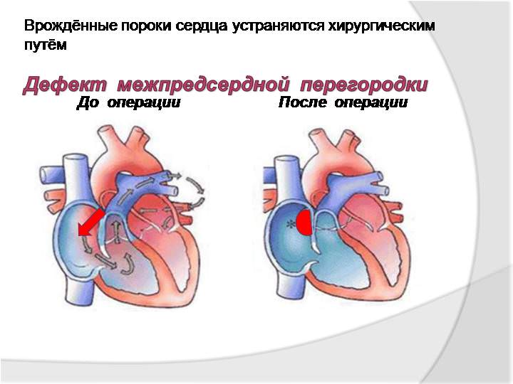 Малые аномалии развития сердца (МАРС) у детей