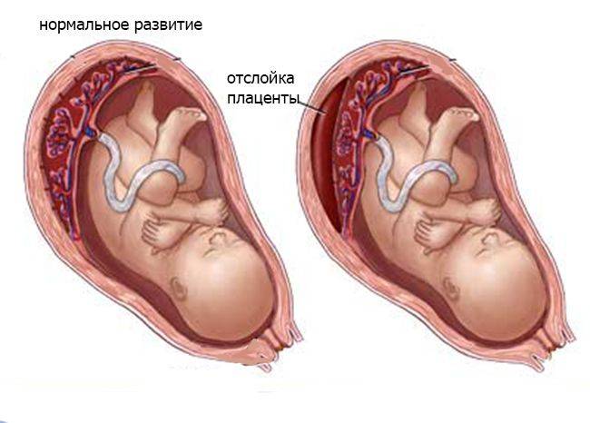 Диагностика и лечение гематомы в матке при беременности