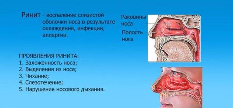 Хроническая заложенность носа: когда нужен врач, причины и лечение