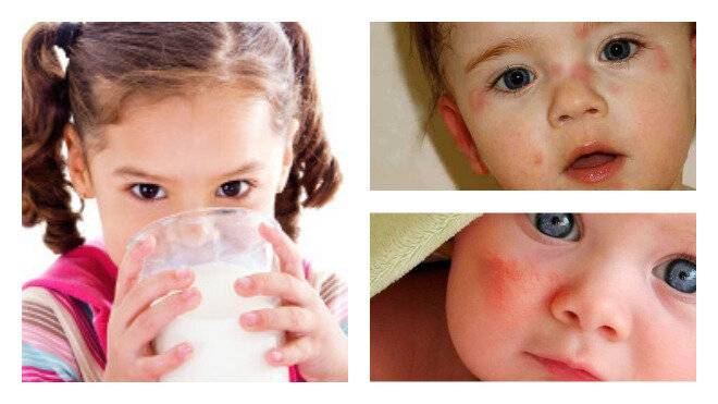 Е. комаровский – аллергия: как лечить у ребенка, аллергия на коровий белок, аллергический ринит