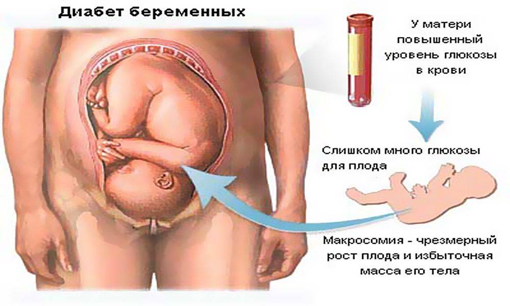 Крупный плод. особенности беременности и родов. крупный ребенок: кесарево или естественные роды