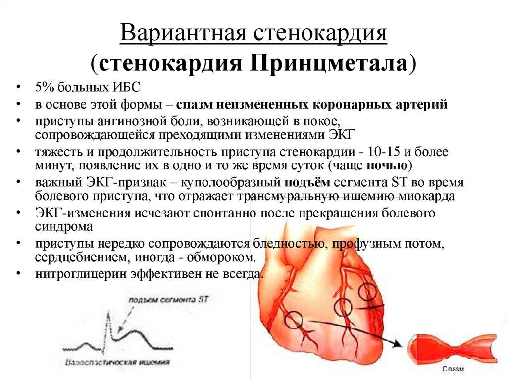 Ибс (ишемическая болезнь сердца) - недостаточность кровоснабжения сердца.