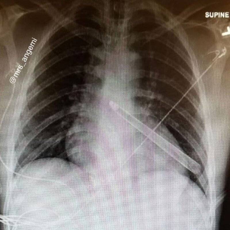 Что показывает рентген сердца, и когда необходимо прибегнуть к такой диагностике?