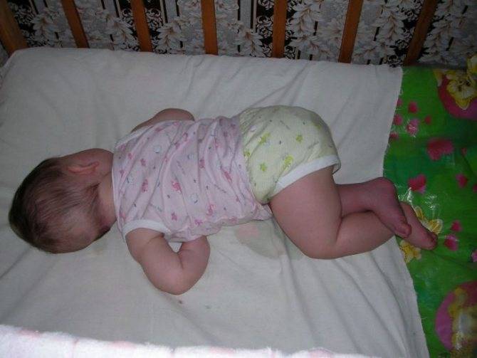 Детское апноэ сна