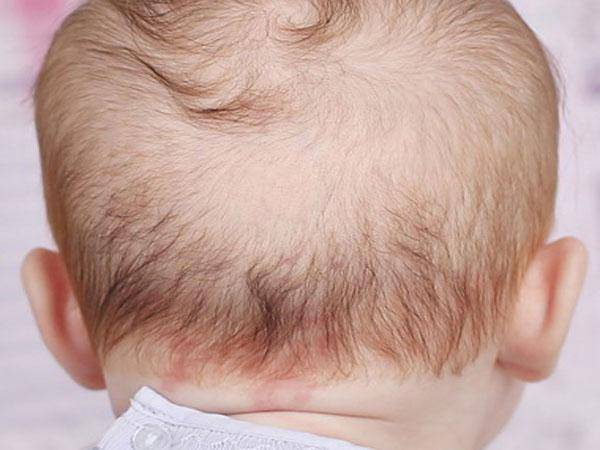 Лекарственные средства от выпадения волос у мужчин: инструкция по применению | компетентно о здоровье на ilive