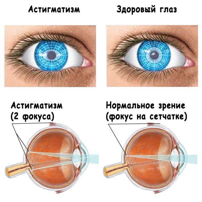 Смешанный астигматизм обоих глаз, лечение и коррекция смешанного астигматизма в клинике fedorovmedcenter.ru