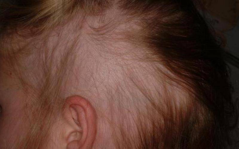 Выпадают волосы у грудничка 3­­–4 месяца на голове и затылке