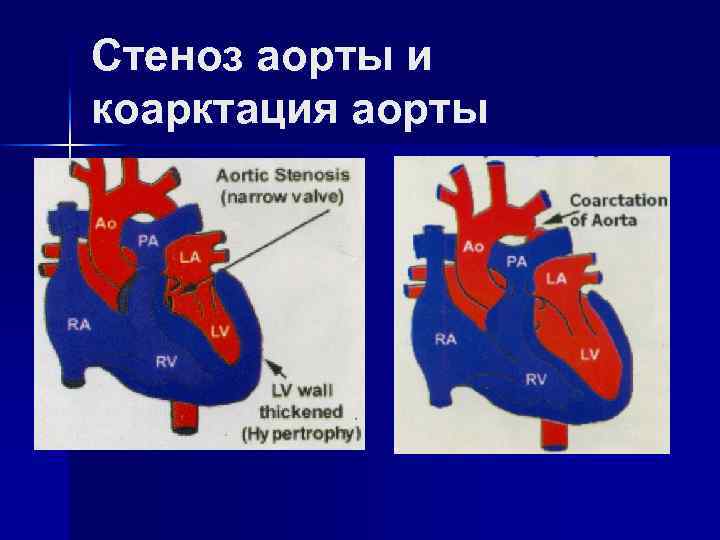 Коарктация аорты у детей - симптомы болезни, профилактика и лечение коарктации аорты у детей, причины заболевания и его диагностика на eurolab