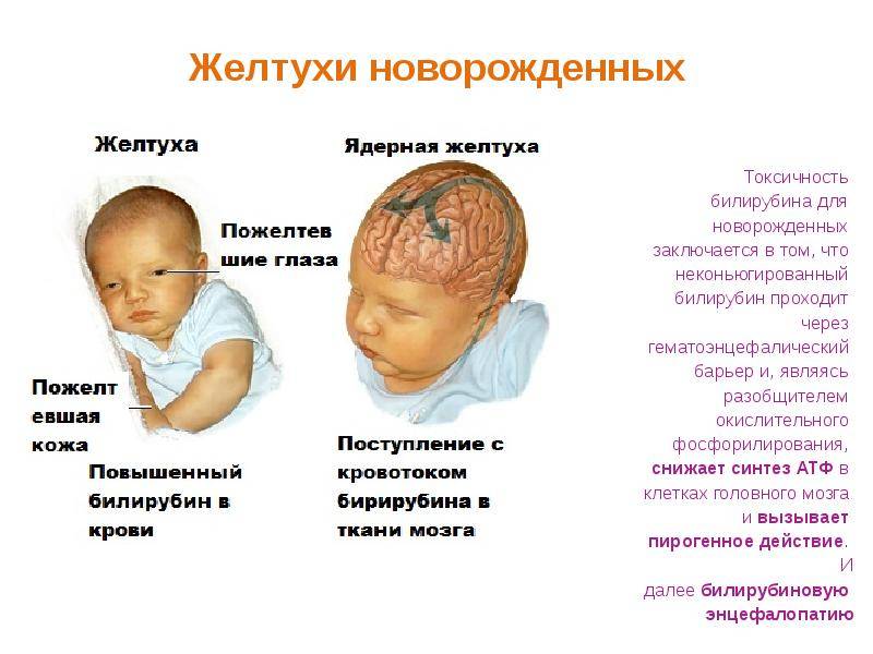Желтуха у новорожденных - причины и последствия, сколько держится, лечение