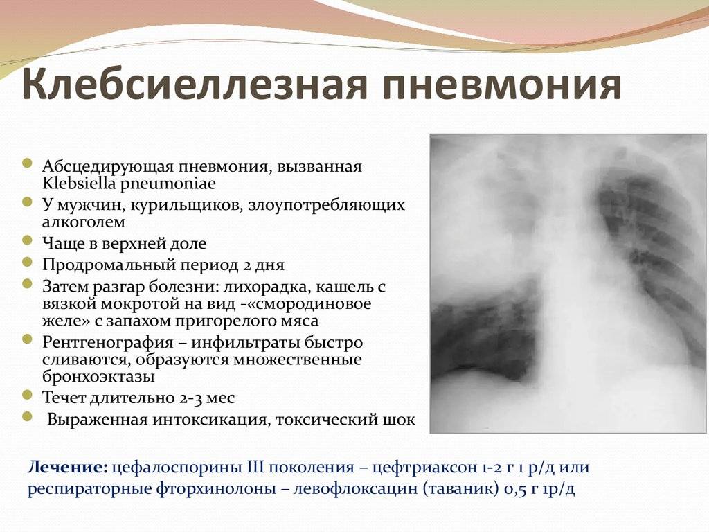 Covid-19 пневмонии. симптомы, методы лечения, реабилитация